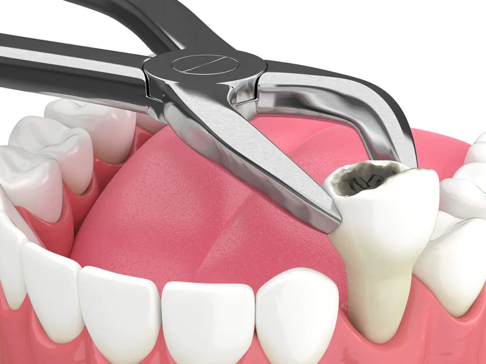 Tooth extractions in Mission, KS at keith + associates dentistry.