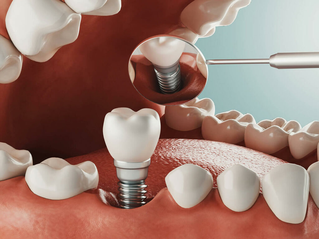 Dental Implants in Overland Park, KS - Keith + Associates Dentistry