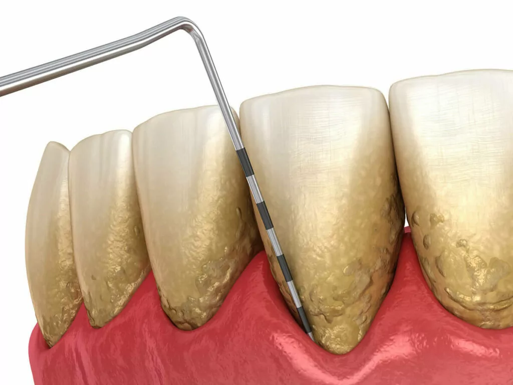 gum disease measurement