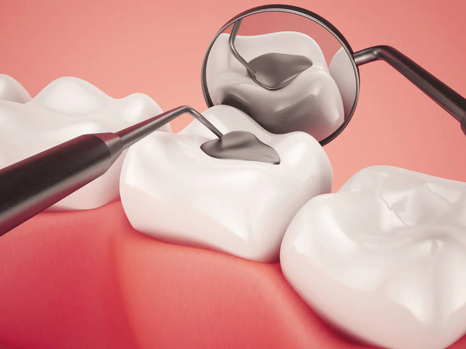 Dental fillings and dental sealants in Mission, KS at keith + associates dentistry.