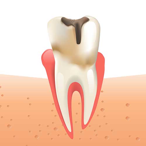 tooth with a cavity